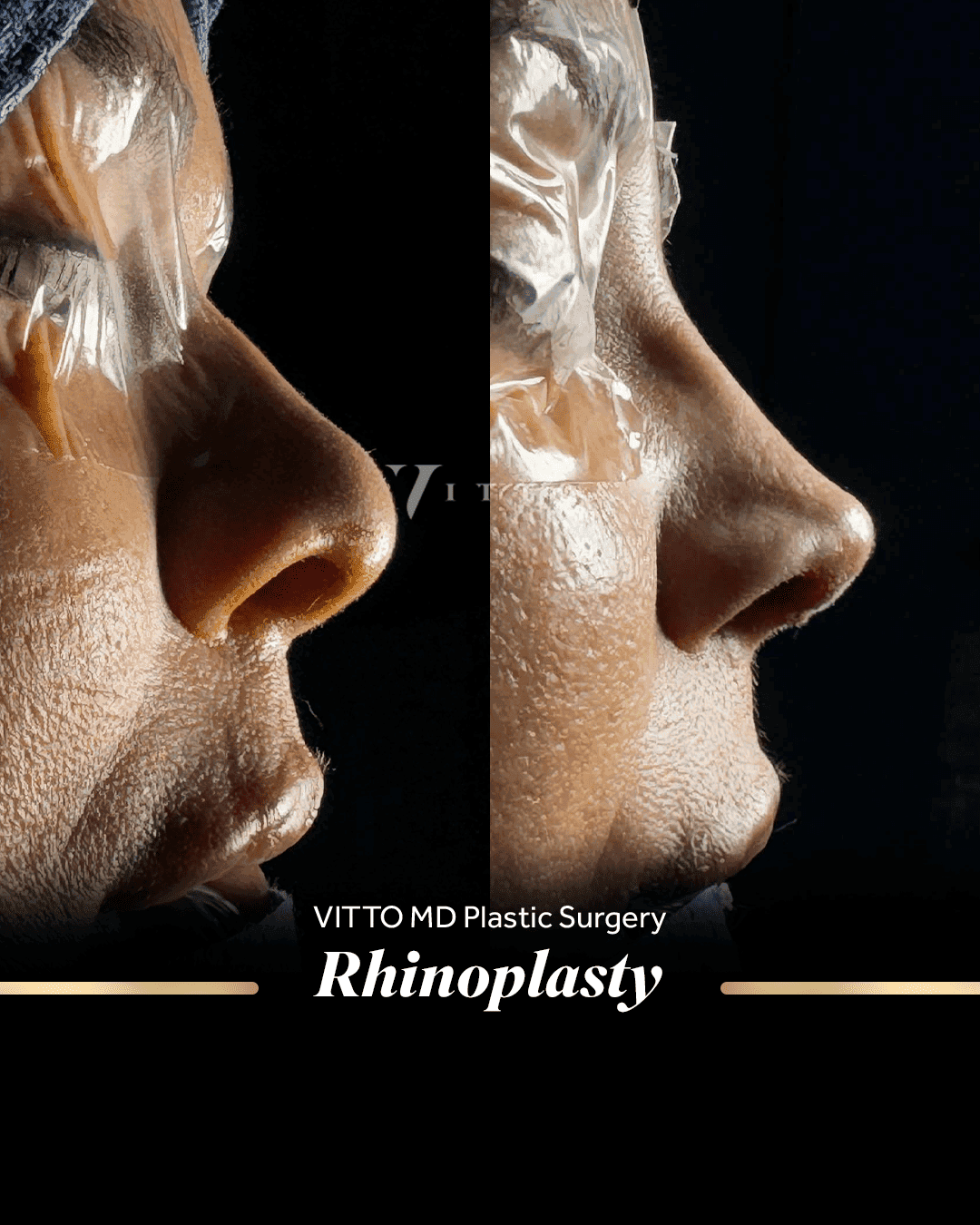 Before and after result at VittoMD in Miami, FL