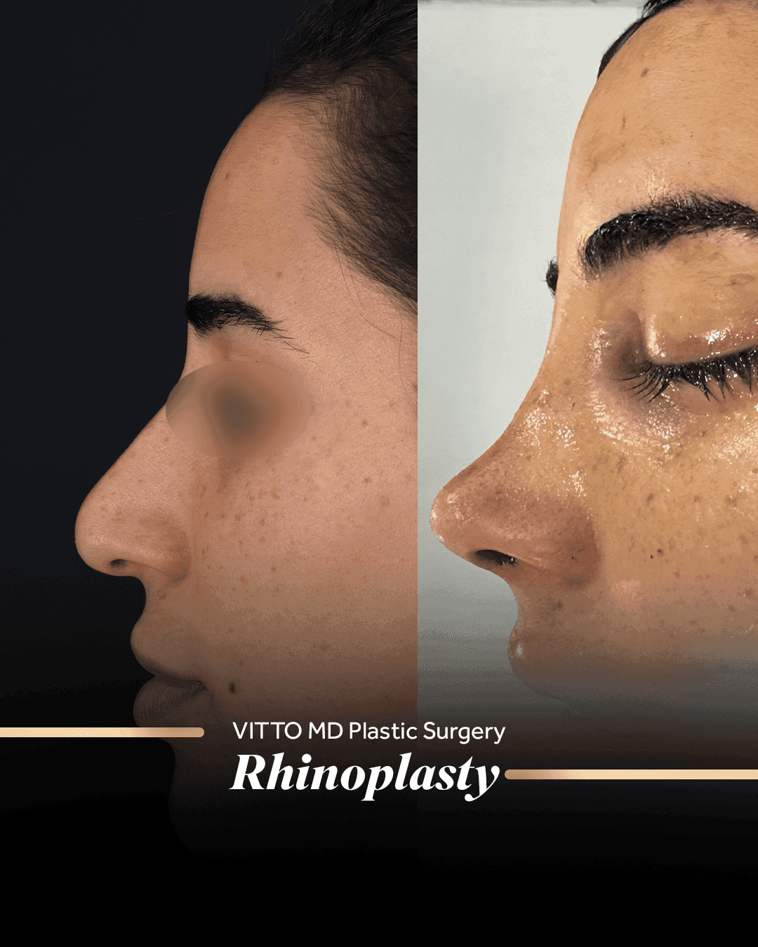 Before and after result at VittoMD in Miami, FL