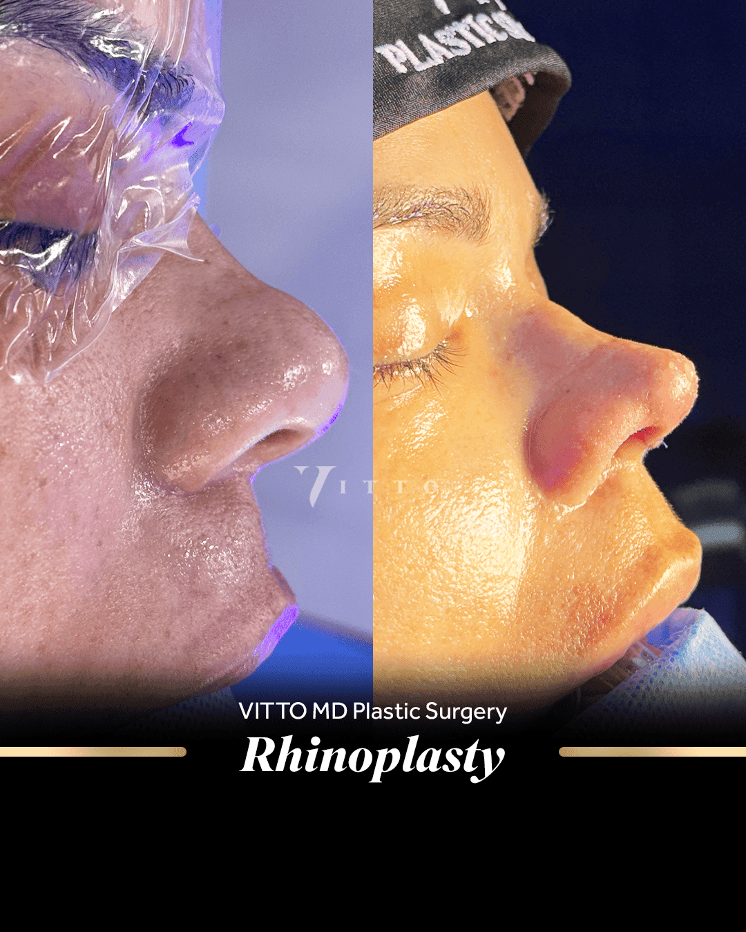 Before and after result at VittoMD in Miami, FL