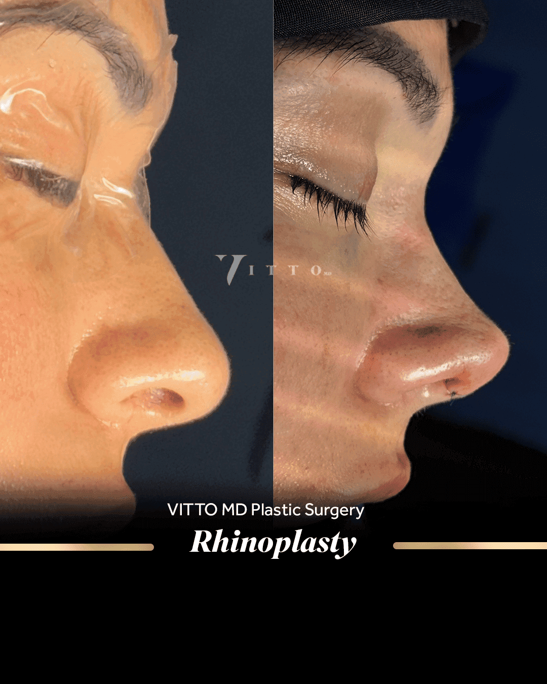Before and after result at VittoMD in Miami, FL