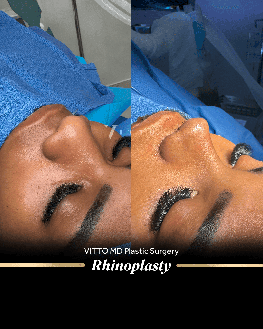 Before and after result at VittoMD in Miami, FL
