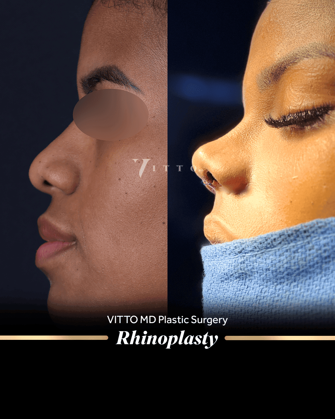 Before and after result at VittoMD in Miami, FL