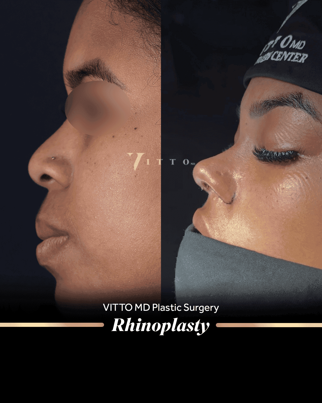 Before and after result at VittoMD in Miami, FL