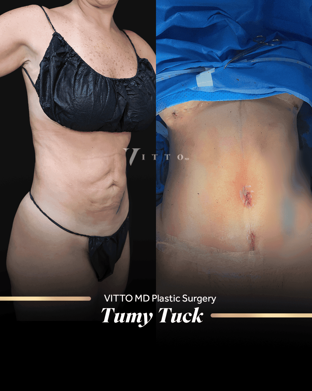 Resultados de Tummy Tuck - 1