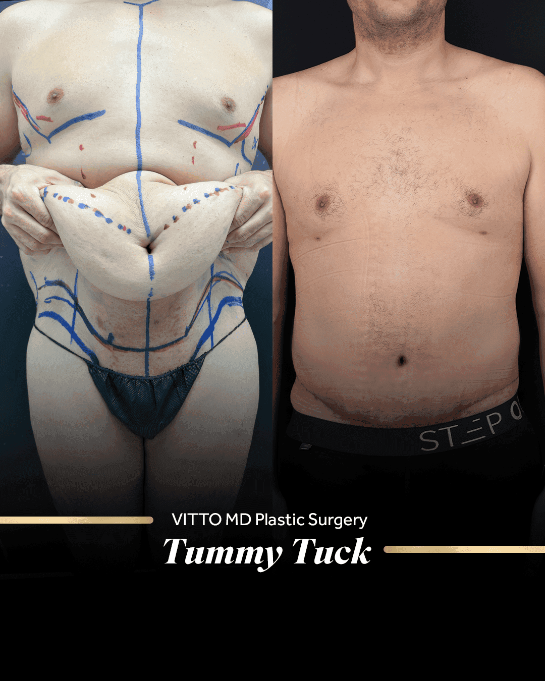 Before and after result at VittoMD in Miami, FL