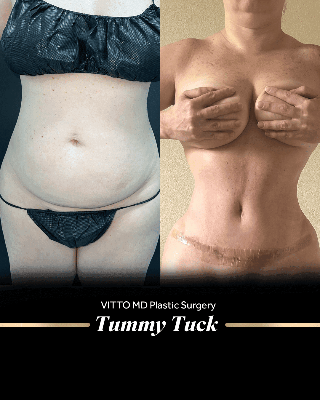 Before and after result at VittoMD in Miami, FL