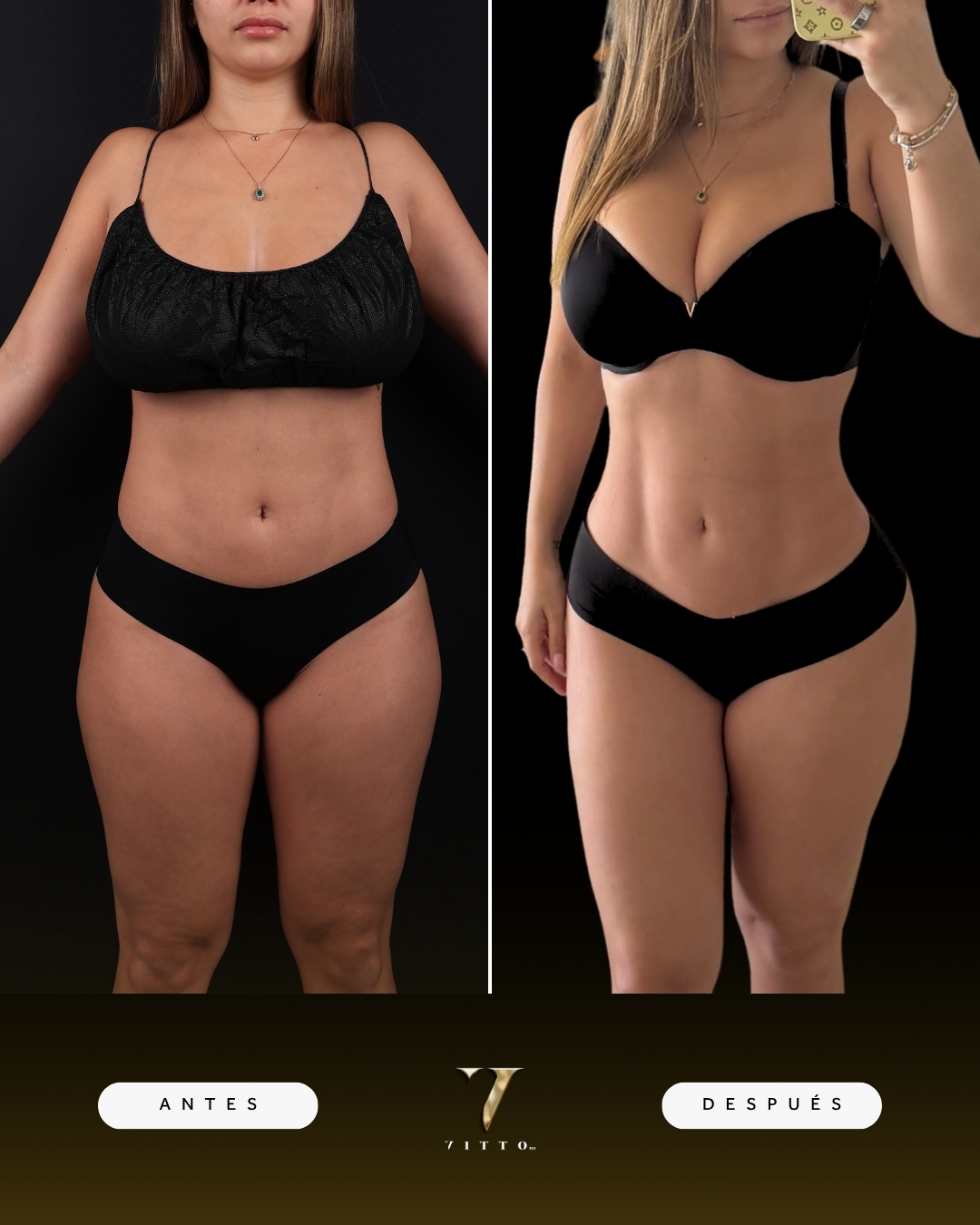 Hourglass silhouette — VittoMD Miami